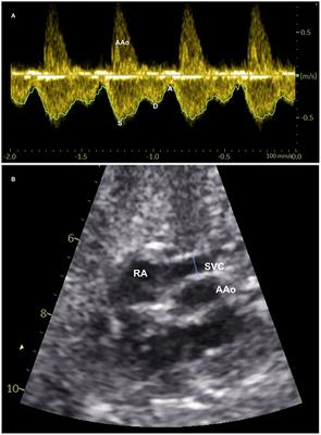 Fetal Superior Vena Cava Blood Flow and Its Fraction of Cardiac Output: A Longitudinal Ultrasound Study in the Second Half of Pregnancy